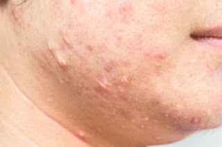 scar-from-acne-face_46178-298.jpg