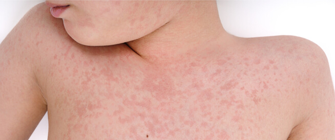 الطفح الجلدي