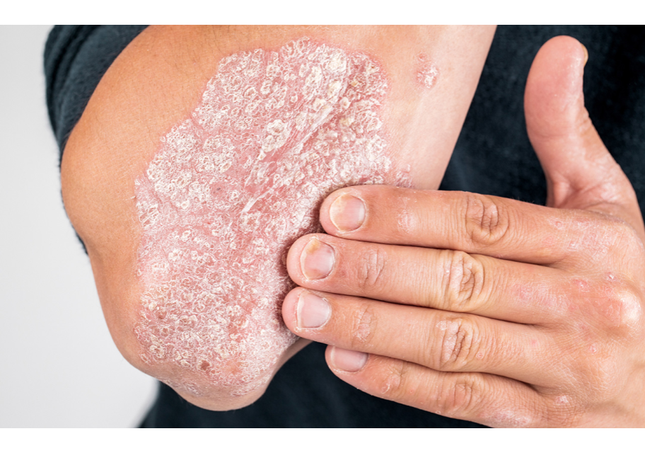 هل الصدفية معدية 