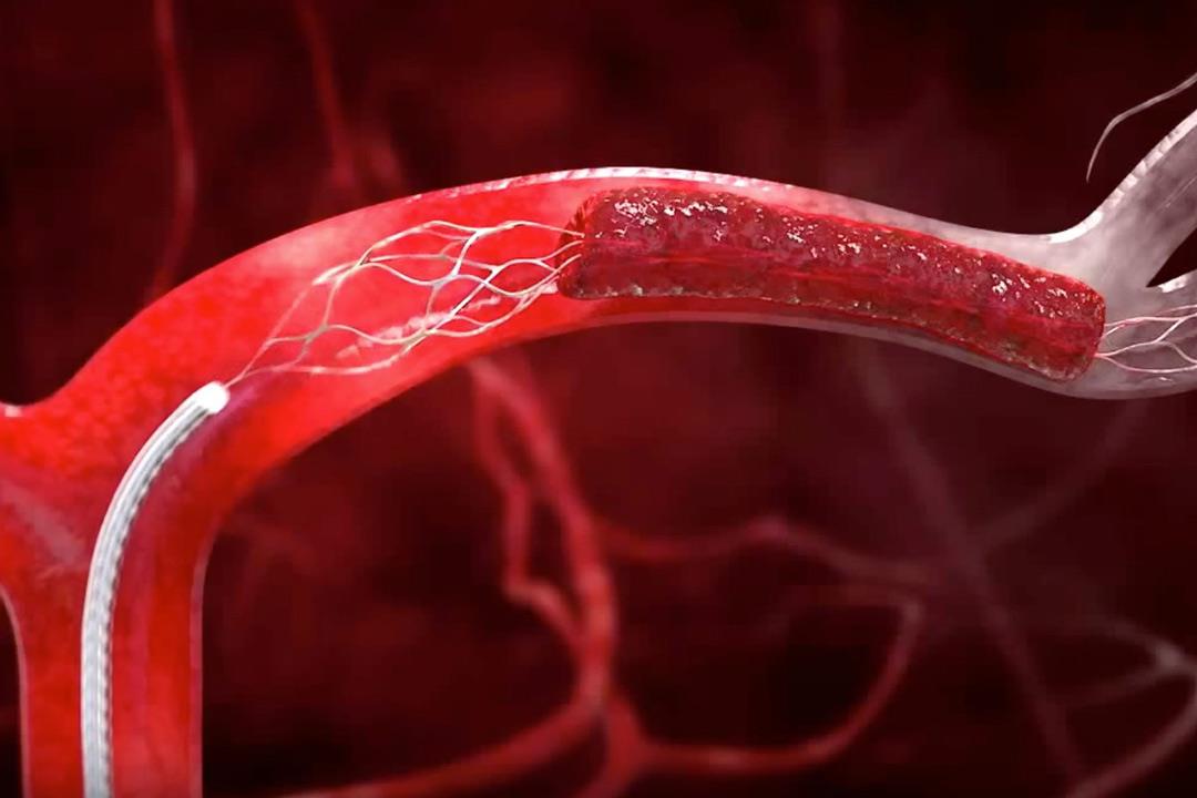هو تورّم أو انتفاخ غير طبيعي في جدار أحد الأوعية الدموية