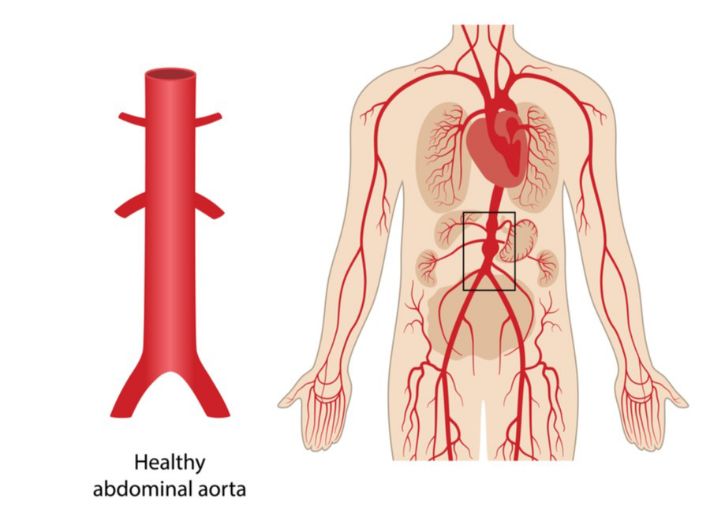 يُعد الشريان الأبهر أضخم شريان موجود في الجسم