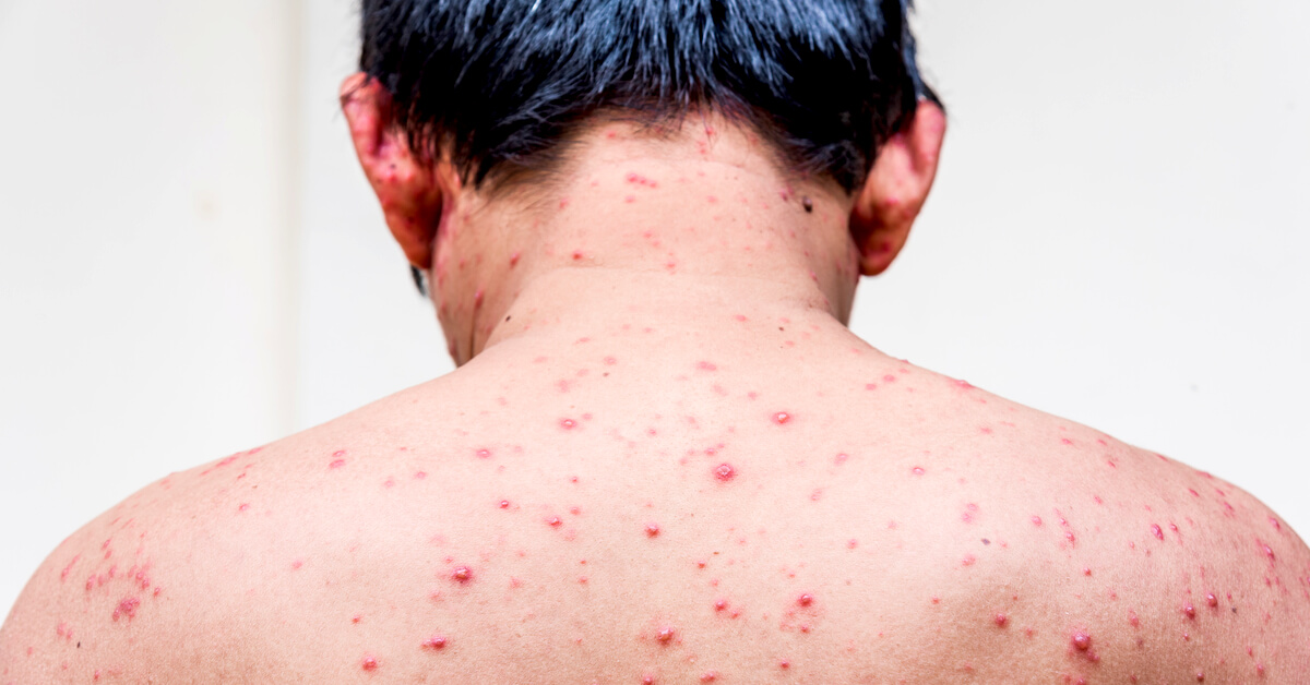 اعراض الايدز الاولية