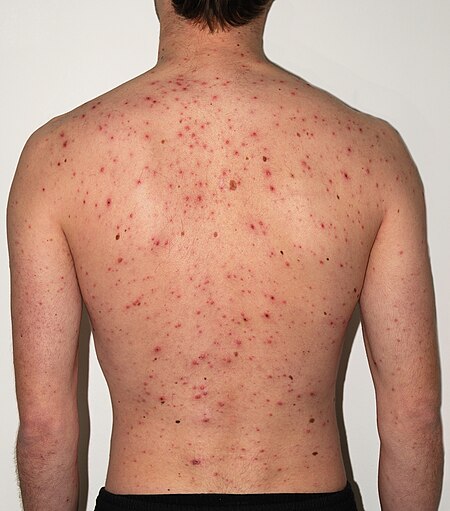 chickenpox-adult-back_1703140323.jpg